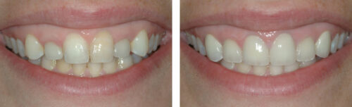 Dental Implants1