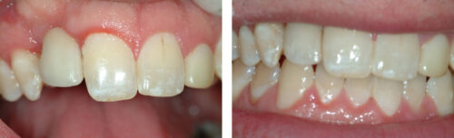 Dental Implants2
