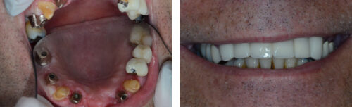 Dental Implants3