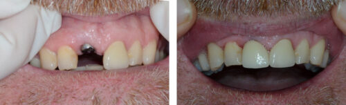 Dental Implants7