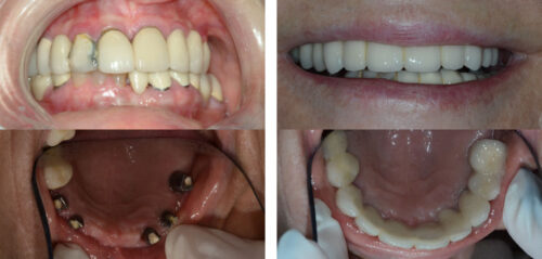 Dental Implants8