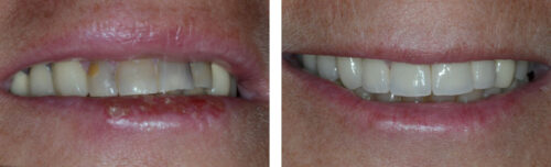 Upper Smile Makeover12