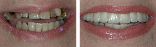 Upper Smile Makeover6