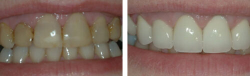 Veneers1