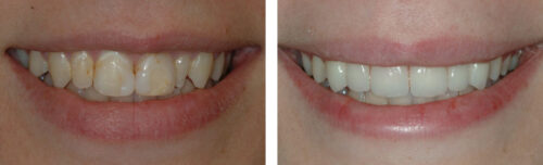 Veneers4