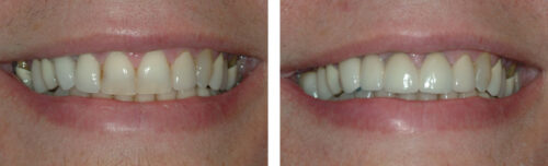 Veneers6