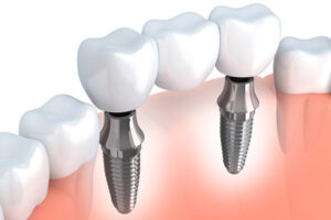 dental-implant-multiple-teeth
