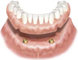 dental-implant-overdenture