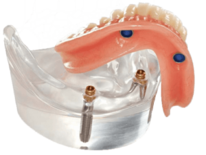 dental-implant-overdenture