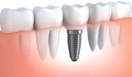 dental-implant