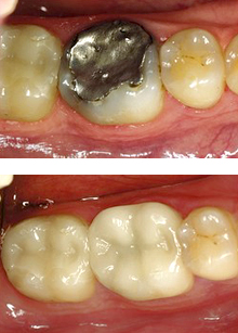 Inlays and Onlays | McOmber Dental