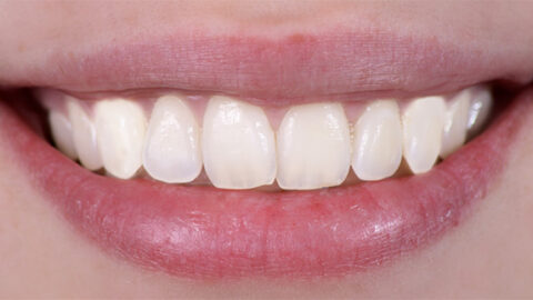 whitening-after