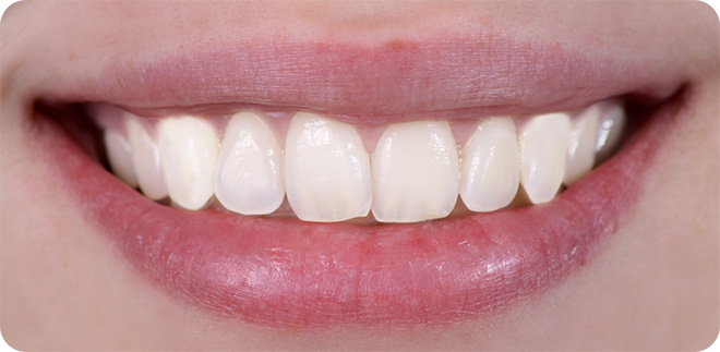 whitening-after